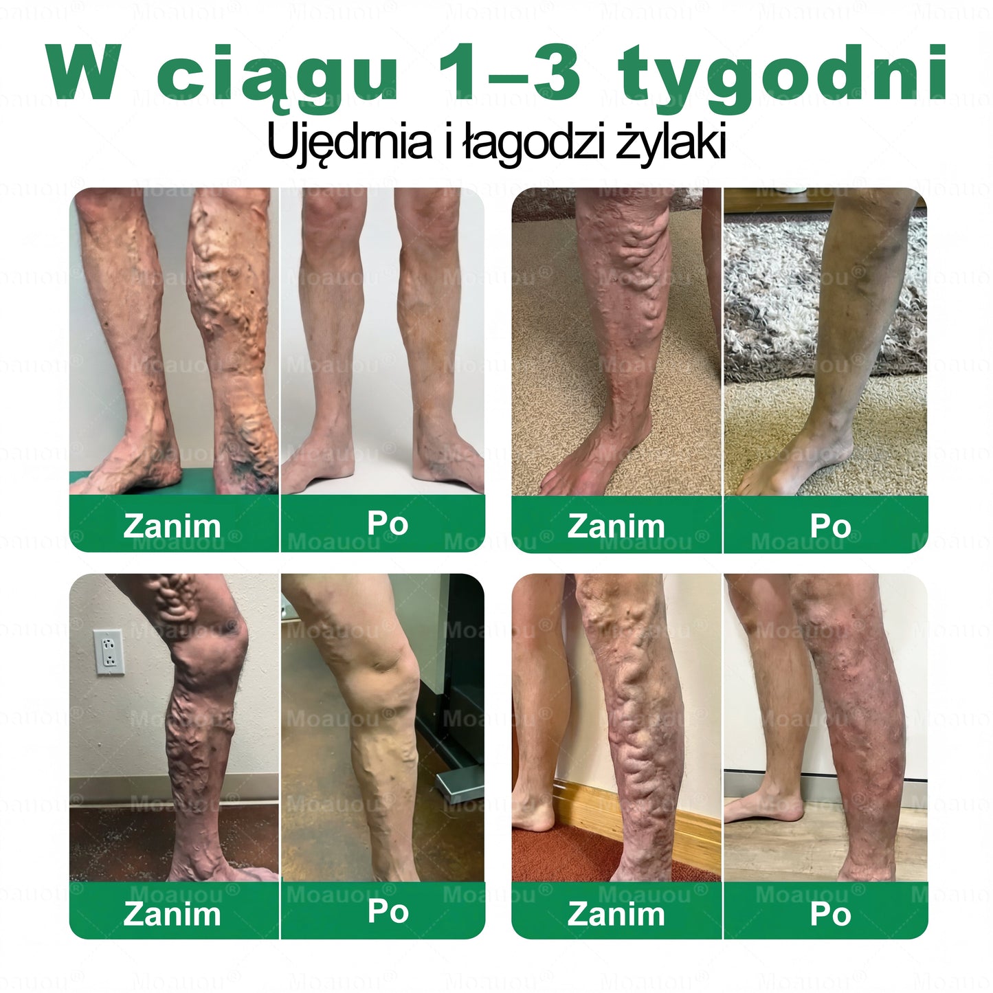 Moauou® Mikronakłuwający Plaster ⚡ Natychmiastowa ulga, długotrwałe efekty – WIELKA PROMOCJA!